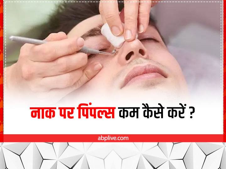 Nose pimples have spoiled the beauty of the face?  Try these home remedies to remove