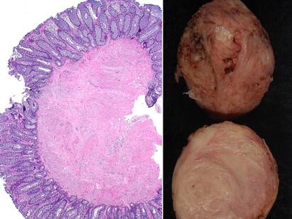 Leiomyoma tumor removed for the first time in Chennai TNN சென்னையில் முதல் முறை..... லியோமியோமா கட்டியை அகற்றி டாக்டர்கள் சாதனை..!