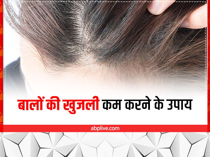 Home Remedies To Cure Itchy Scalp | बालों की खुजली से हो रहे हैं परेशान?  आजमाएं ये 4 असरदार नुस्खे
