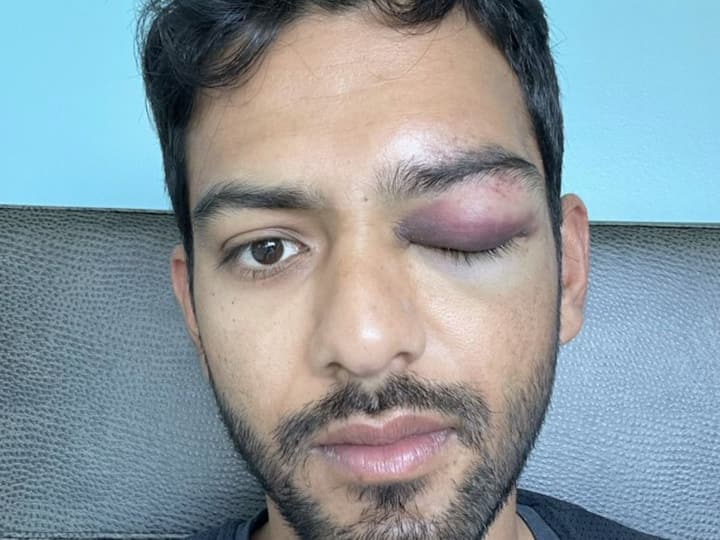 Former India U-19 Skipper Unmukt Chand Sustains Scary Eye Injury - See Pics Former India U-19 Skipper Unmukt Chand Sustains Scary Eye Injury - See Pics