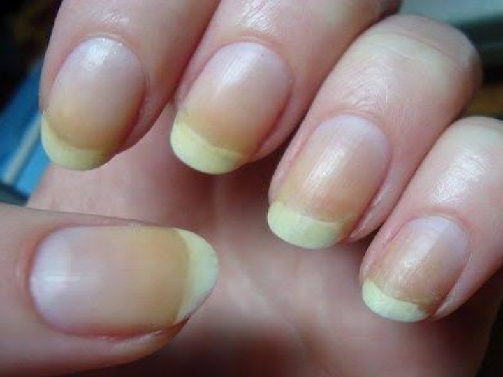 These 5 Mark On Nails Can Be Sign Of Skin Cancer - Amar Ujala Hindi News  Live - आपके नाखूनों पर भी हैं ऐसे निशान तो सावधान! तुरंत कराएं 'स्किन  कैंसर' की जांच
