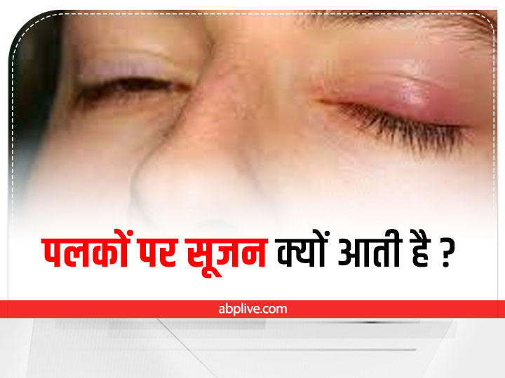 What Are The Causes Of Swollen Eyelids? Learn Remedies And Home Remedies