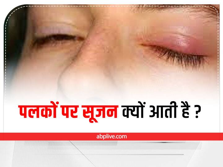 What are the causes of swollen eyelids? Learn Remedies and Home Remedies