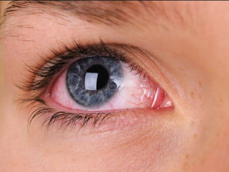 Are your eyes red Not just Madras Eye there are many more reasons learn கண்கள் சிவக்கிறதா… மெட்ராஸ் ஐ மட்டுமல்ல, இன்னும் நிறைய காரணங்கள்! தெரிந்துகொள்ளுங்கள்…