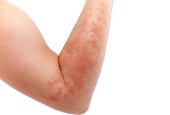 If the skin becomes swollen along with redness, be careful, this is a sign of the disease Health Tips:ત્વચા લાલાશની સાથે સોજો આવી જતો હોય તો  સાવધાન આ બીમારીના છે સંકેત