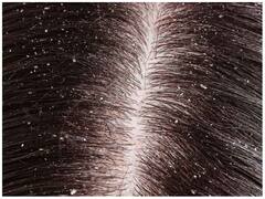 सर्दियों के मौसम में होता है डैंड्रफ, यहां जानिए इससे होने वाले नुकसान