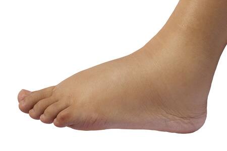 Do your feet get swollen? Here are the possible causes కాళ్లు, పాదాల్లో వాపు కనిపిస్తోందా? నిర్లక్ష్యం వద్దు ప్రమాదకరం కావచ్చు