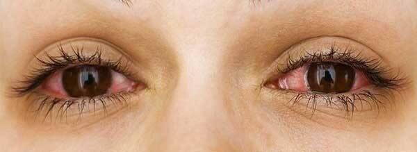 ਲੈਪਟਾਪ 'ਤੇ ਕੰਮ ਕਰਨ, ਟੀਵੀ ਜਾਂ ਮੋਬਾਈਲ ਨੂੰ ਜ਼ਿਆਦਾ ਦੇਰ ਤਕ ਦੇਖਣ ਨਾਲ ਅੱਖਾਂ 'ਚ ਤਣਾਅ ਹੋਣ ਲੱਗਦਾ ਹੈ। ਅਜਿਹੇ 'ਚ ਅੱਖਾਂ 'ਚ ਖੁਜਲੀ ਸ਼ੁਰੂ ਹੋ ਜਾਂਦੀ ਹੈ। ਇਸ ਨਾਲ ਇਨਫੈਕਸ਼ਨ ਵਧਦੀ ਹੈ। ਅੱਖਾਂ ਲਾਲ ਹੋ ਜਾਂਦੀਆਂ ਹਨ।