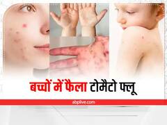 उज्जैन संभाग के कई जिलों में बच्चों में टोमैटो फ्लू का प्रसार, जानिए- लक्षण और बचाव के तरीके