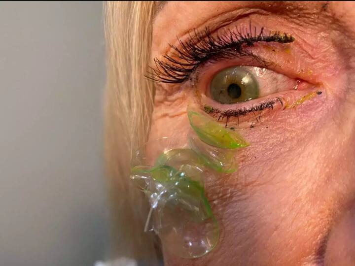 Doctor removes 23 contact lenses from woman eye in THIS shocking viral video Watch Video: எடுக்க எடுக்க வந்துகிட்டே இருக்கு..! ஒரே கண்ணில் 23 லென்ஸ்..  'ஷாக்'கில் உறைந்த டாக்டர்..!