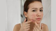 Skin Care Tips: এই সহজ পদ্ধতিগুলোতেই দূর হবে ব্রণর সমস্যা