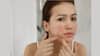 Skin Care Tips: এই সহজ পদ্ধতিগুলোতেই দূর হবে ব্রণর সমস্যা