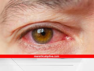 Health Tips : सावधान! 'कंजंक्टिवायटिस' या डोळ्यांच्या आजाराचा वाढतोय धोका; जाणून घ्या लक्षणं आणि प्रतिबंधात्मक उपाय