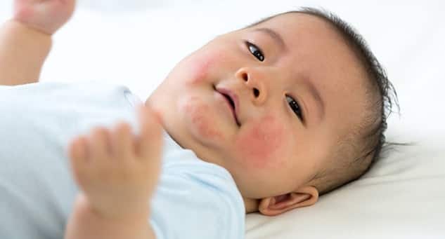 Does your child suffer from food allergies? Food Allergy: બાળકને સ્કિન પર વારંવાર થઇ જાય છે ફોલ્લીઓ તો હોઇ શકે છે કારણ