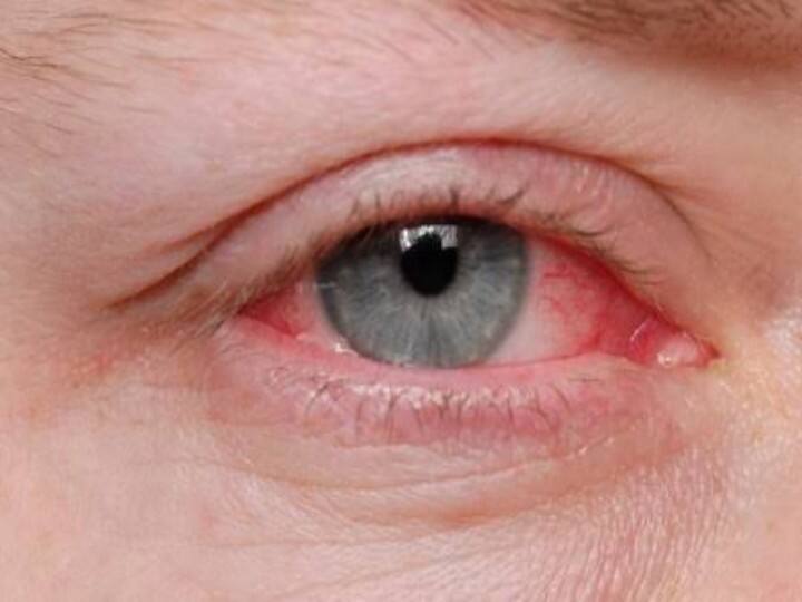 health tips What is Pink Eye symptoms and treatment in hindi Health Tips: Pink Eye' से सावधान ! जानें क्या है ये बीमारी और इसके लक्षण, क्यों अस्पताल में बढ़ रही मरीजों की संख्या