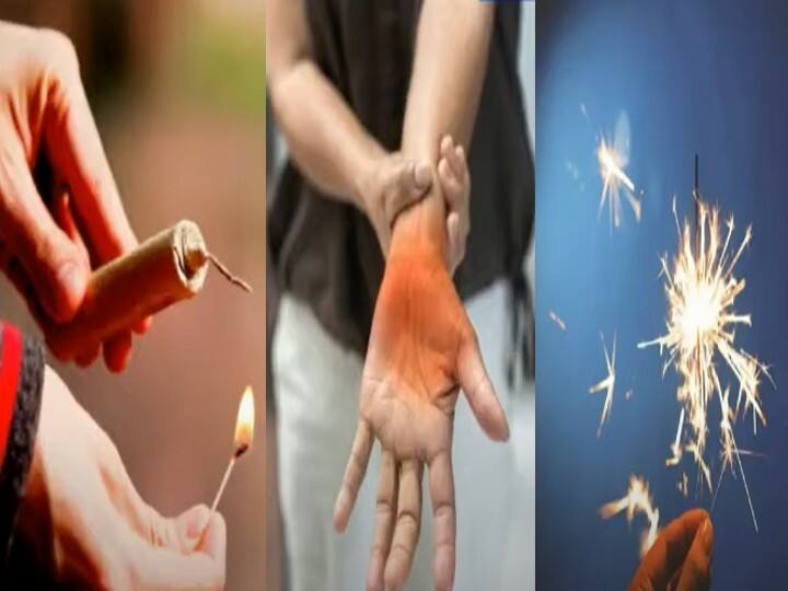 Diwali 2022: Hands and feet get burnt while lighting the firecracker, Then do this work immediately before going to the hospital Diwali 2022: पटाखे जलाते समय जल जाए हाथ-पैर तो अस्पताल जाने से पहले तुरंत कर लें ये काम, पढ़ें ये काम की खबर