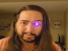 US Man Loses Eye To Cancer, Creates Prosthetic Eye With A Flashlight