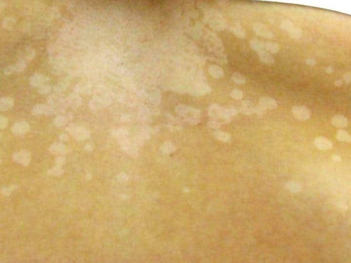 Vitiligo Leukoderma symptoms causes and complication सफेद दाग यानी Vitiligo के ऐसे होते हैं शुरुआती लक्षण, शरीर में आते हैं ऐसे बदलाव