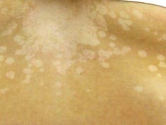 सफेद दाग यानी Vitiligo के ऐसे होते हैं शुरुआती लक्षण, शरीर में आते हैं ऐसे बदलाव