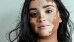 Vitiligo Leukoderma : ਚਿੱਟੇ ਧੱਬਿਆਂ ਭਾਵ Vitiligo ਦੇ ਅਜਿਹੇ ਹੁੰਦੇ ਨੇ ਸ਼ੁਰੂਆਤੀ ਲੱਛਣ, ਸਰੀਰ 'ਚ ਆਉਂਦੇ ਅਜਿਹੇ ਬਦਲਾਅ