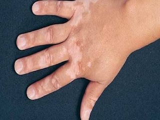 Vitiligo Leukoderma : त्वचेवर दिसणारे पांढरे डाग कसे तयार होतात? असू शकतो Vitiligo आजार; वेळीच ओळखा 'ही' लक्षणं