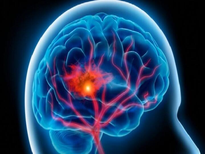 Health Tips : 85 சதவீதம் பேருக்கு பக்கவாதம் பற்றிய விழிப்புணர்வே இல்லை..! ஆய்வில் அதிர்ச்சி தகவல்...