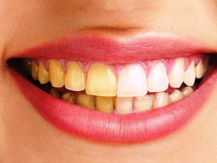 How to whiten teeth naturally follow some home remedies Whiten Teeth: दांत के पीलेपन को दूर करने का देसी जुगाड़ सिर्फ 5 मिनट में आएगी मोती जैसी चमक