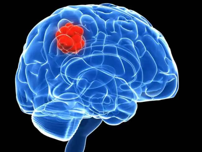 Brain Tumor: Initial symptoms of brain tumor are very minor, don't ignore it, save like this Brain Tumor : ਬ੍ਰੇਨ ਟਿਊਮਰ ਦੇ ਸ਼ੁਰੂਆਤੀ ਲੱਛਣ ਹੁੰਦੇ ਬੇਹੱਦ ਮਾਮੂਲੀ, ਨਾ ਕਰੋ ਨਜ਼ਰਅੰਦਾਜ਼, ਇਸ ਤਰ੍ਹਾਂ ਕਰੋ ਬਚਾਅ