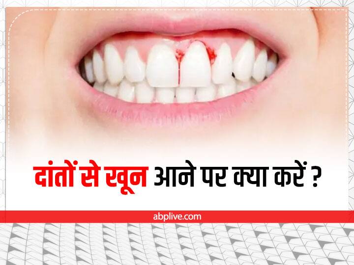 Home Remedies to Cure Teeth Bleeding दांतों से आ रहा है खून, तो इन उपायों को करने से मिलेगा तुरंत आराम