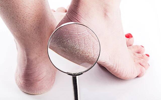 Cracked Heels: If you are bothered by cracked heels, eat this vitamin instead of cream, the problem will be gone Cracked Heels : ਜੇਕਰ ਤੁਸੀਂ ਫਟੀ ਅੱਡੀਆਂ ਤੋਂ ਹੋ ਪਰੇਸ਼ਾਨ ਤਾਂ ਕ੍ਰੀਮ ਨਹੀਂ ਸਗੋਂ ਖਾਓ ਇਹ ਵਿਟਾਮਿਨ, ਸਮੱਸਿਆ ਹੋਵੇਗੀ ਦੂਰ