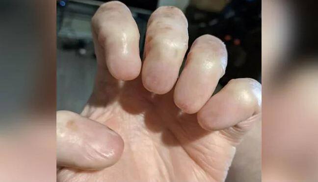 viral image of a man hand without nails shocks the internet Shocking: ਬਿਨਾਂ ਨਹੁੰਆਂ ਦੇ ਹੱਥ... ਸੋਸ਼ਲ ਮੀਡੀਆ 'ਤੇ ਲੋਕਾਂ ਨੂੰ ਹੈਰਾਨ ਕਰ ਰਹੀ ਹੈ ਵਾਇਰਲ ਇਹ ਤਸਵੀਰ, ਜਾਣੋ ਕੀ ਹੈ ਸੱਚ?