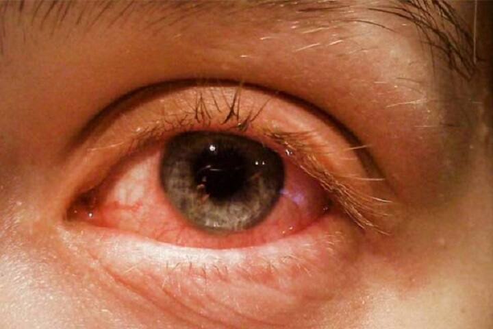 Be careful smog can damage the eyes सावधानी बरतिए, फेफड़े ही नहीं आंखों को भी नुकसान पहुंचा सकता है स्मॉग