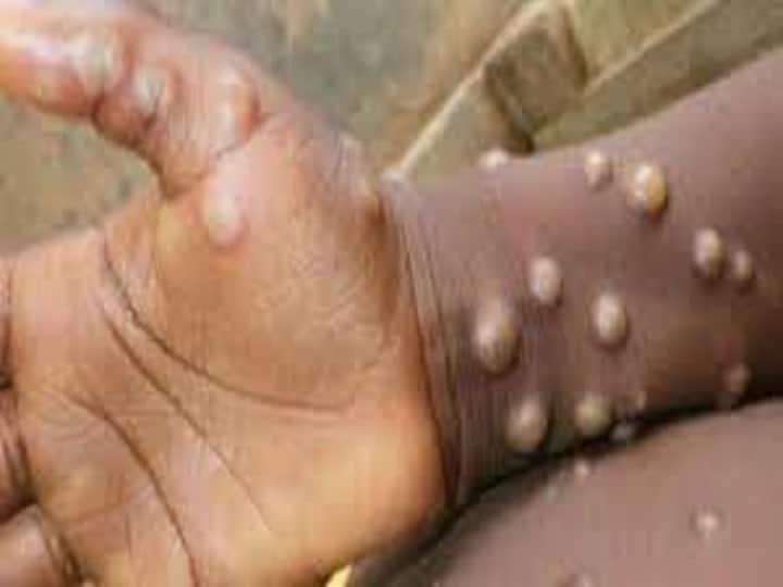 monkeypox is no longer a global health emergency declares world health Organization Monkey Pox: दिलासादायक! कोरोनानंतर आणखी एक महासाथ आटोक्यात, आरोग्य आणीबाणी हटवली