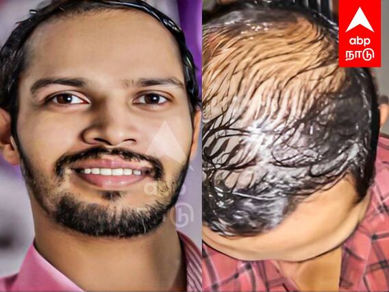 Kerala : ”தலை முடி மட்டுமில்ல புருவ முடியும் போச்சு..!”தள்ளிப்போன திருமணம்..விபரீத முடிவெடுத்த இளைஞர்