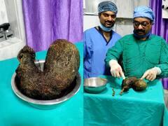 तब्बल 7 वर्ष स्वत:चेच केस खाण्याची सवय, 13 व्या वर्षी पोटातून एक किलो केसांचा गोळा काढला