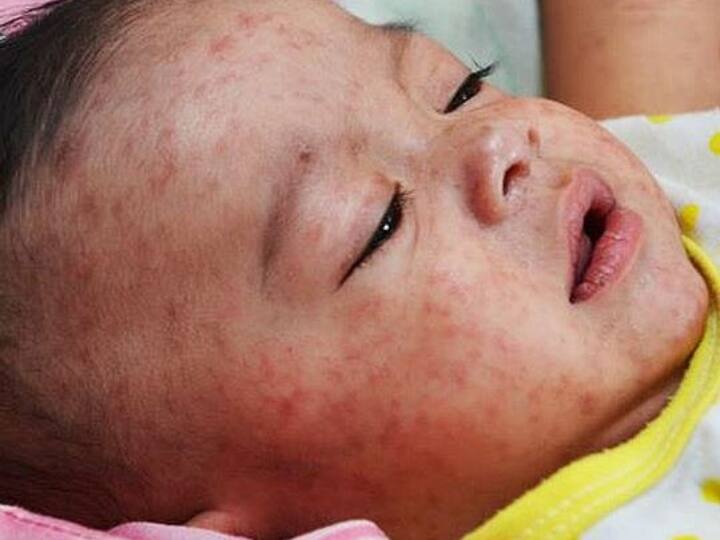 Mumbai Union Ministry Health Family Welfare deployed high level team outbreak of measles under control ANN Mumbai: मुंबई में खसरे से निपटने के लिए केंद्र ने तैनात की टीम, 90 लोग बीमारी के चपेट में आए