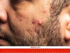 Acne Treatment: महज कुछ दिनों में इन 4 तरीकों से दूर करें एडल्ट एक्ने और पिम्पल्स