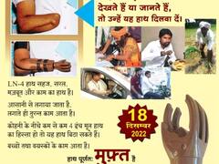 दुर्ग: अमेरिका में बने कृत्रिम हाथ से लोगों को मिलेगा नया जीवन, जानिए- कब से शुरू होगा शिविर