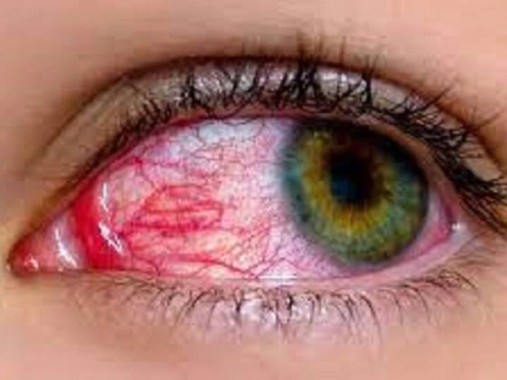 Madras eye Infection Cases Rise in Chennai Five-fold Increase in Conjunctivitis over last 7 days Check Common Symptoms Treatment Madras Eye: சென்னையை அச்சுறுத்தும் மெட்ராஸ் ஐ..! ஒரு வாரத்தில் 5 மடங்கு பாதிப்பு அதிகரிப்பு..! தப்பிப்பது எப்படி..?