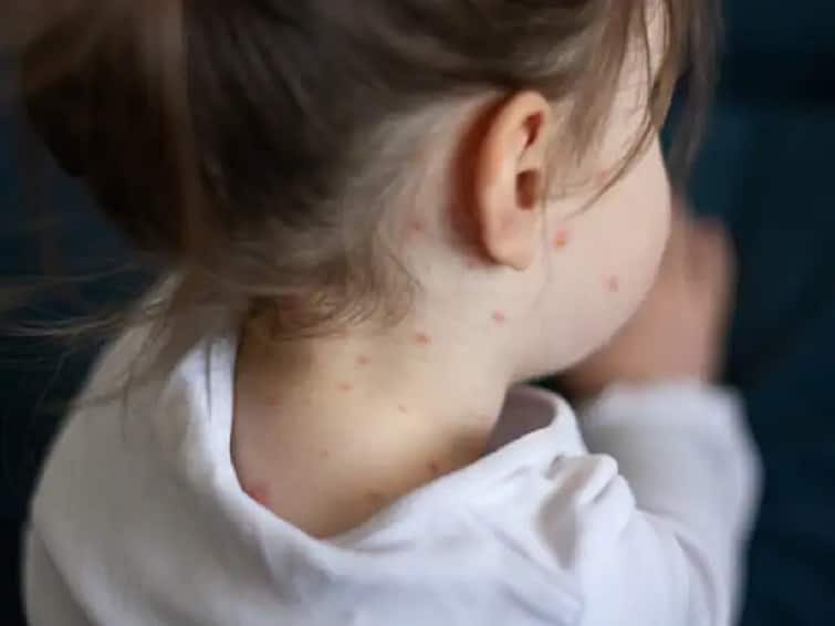 maharashtra News Aurangabad News Another child tests positive for measles in Aurangabad  Vaccination campaign in high risk areas Measles Disease: चिंता वाढली! औरंगाबादमध्ये आणखी एक बालक गोवर पॉझिटिव्ह, हाय रिस्क भागात लसीकरण मोहीम  