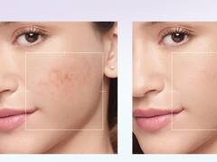 पिगमेंटेशन और डार्क स्पॉट से पाएं छुटकारा, जानिये कैसे फायदा करते हैं ग्लाइकोलिक एसिड वाले फेस सीरम