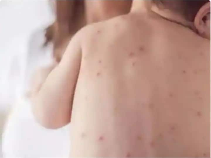 Measles Threat Rises In India And WHO Says Is Due To Covid