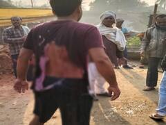 सुपौल में भूमि विवाद को लेकर युवक पर एसिड अटैक, पीठ का हिस्सा बुरी तरह झुलसा