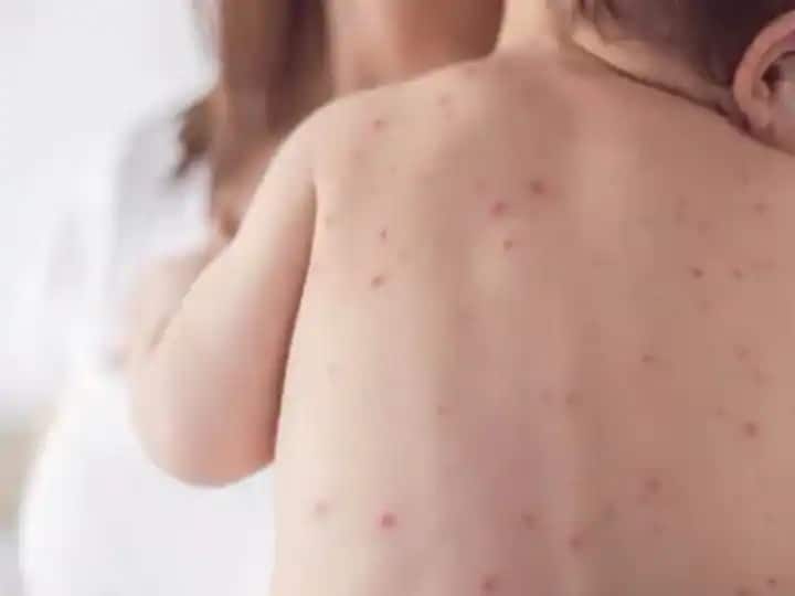 Measles Outbreak : गोवरची नेमकी कारणे कोणती? काय काळजी घ्यावी? गोवरशी संबंधित दहा प्रश्नांची उत्तरं Measles Outbreak in Mumbai What are the exact causes of measles know Answers to ten questions related to measles Measles Outbreak : गोवरची नेमकी कारणे कोणती? काय काळजी घ्यावी? गोवरशी संबंधित दहा प्रश्नांची उत्तरं