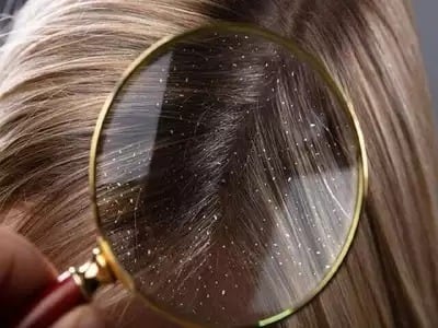 Hair Dandruff easy home remedies to get rid of dandruff Hair Dandruff: हिवाळ्यात केसांत वारंवार कोंडा होतो? 'या' घरगुती टीप्स करा फॉलो