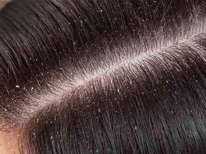 Easy Home Remedies To Get Rid Of Dandruff Hair Dandruff: सर्दी में डैंड्रफ की प्रॉब्लम चुटकियों में हो जाएगी दूर, फॉलों करें यह घरेलू ट्रिक्स