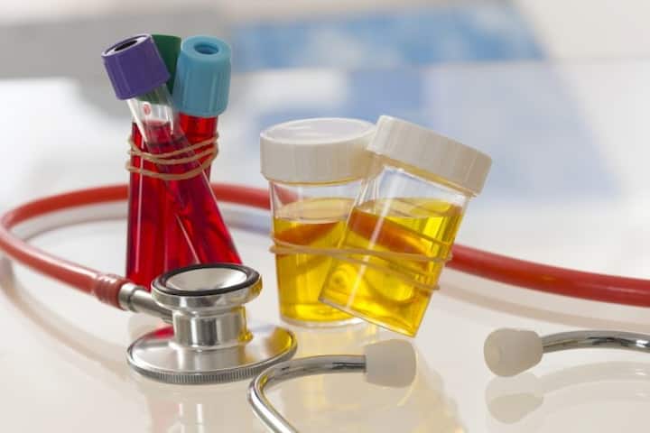 ਇਸ ਤੋਂ ਬਾਅਦ ਯੂਰਿਨ ਟੈਸਟ ਕੀਤਾ ਜਾਂਦਾ ਹੈ ਜਿਸ ਵਿੱਚ ਵਿਅਕਤੀ ਦੇ ਸਰੀਰ ਵਿੱਚ ਗਲੂਕੋਜ਼ ਅਤੇ ਪ੍ਰੋਟੀਨ ਦੀ ਮਾਤਰਾ ਦਾ ਪਤਾ ਲਗਾਇਆ ਜਾਂਦਾ ਹੈ।