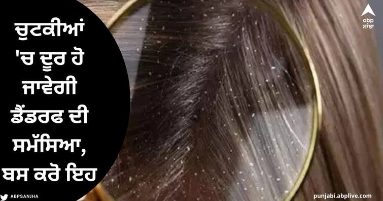 Hair dandruff: Are you also troubled by the problem of dandruff in winter, follow these home remedies Hair dandruff : ਕੀ ਤੁਸੀਂ ਵੀ ਸਰਦੀਆਂ 'ਚ ਡੈਂਡਰਫ ਦੀ ਸਮੱਸਿਆ ਦੀ ਸਮੱਸਿਆ ਤੋਂ ਹੋ ਪਰੇਸ਼ਾਨ, ਅਪਣਾਓ ਇਹ ਘਰੇਲੂ ਨੁਸਖੇ