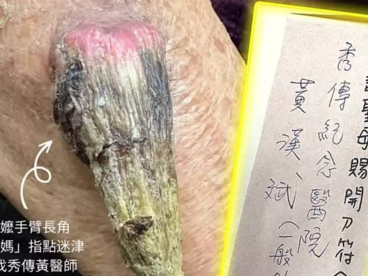 china 91 year old grandmother has ultra rare 'fairy' horn growing on her arm Viral Pic : 91 வயது மூதாட்டிக்கு கையில் வளர்ந்த கொம்பு..! ஆச்சிரியத்தில் உறைந்த மருத்துவ உலகம்..!