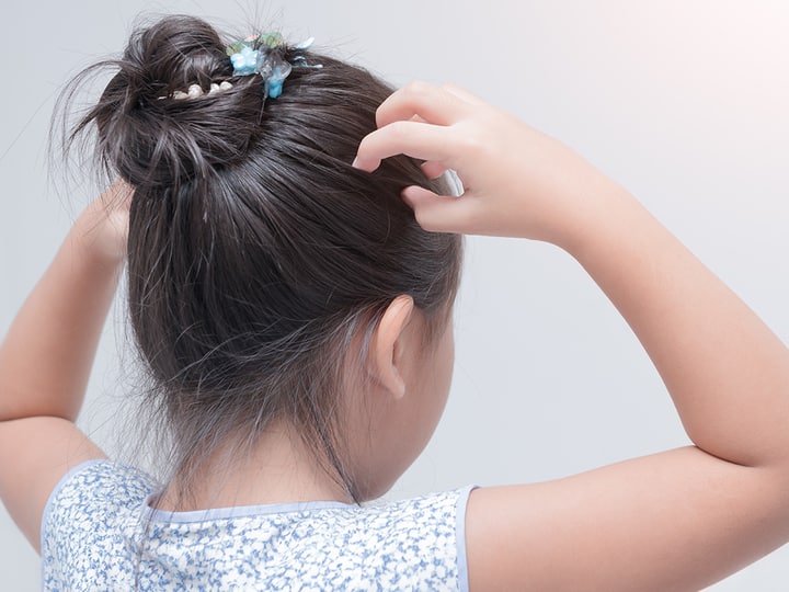 effective home remedies to remove lice from hair permanently Head Lice: क्या आप भी जुओं से परेशान हैं? जानिए जुएं होने के कारण और इसे दूर करने के उपाय